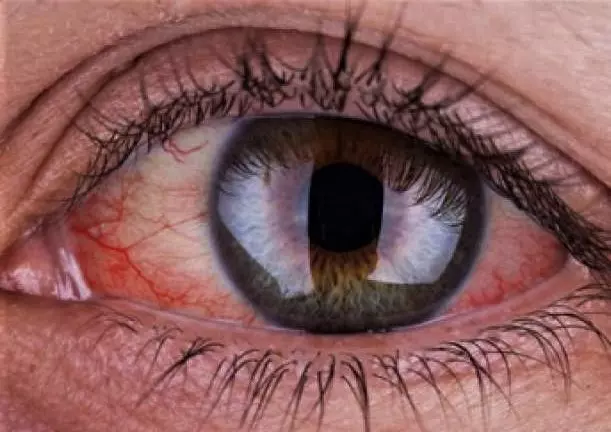 Ochni Zahvoryuvannya