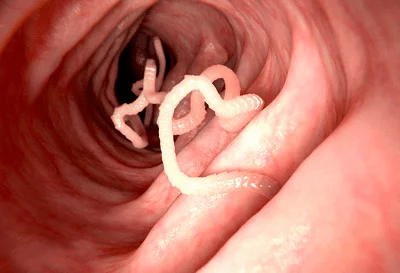 Parazyty Glysty Symptomy Oznaky Likuvannya